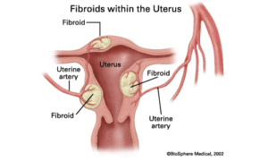 Fibroids within the Uterus