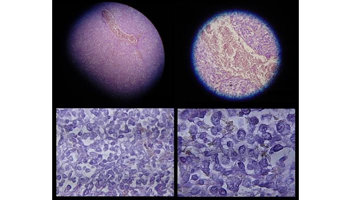 mesothelioma cell types