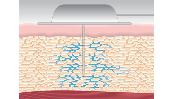 Capillary Med Tech Capillary Biomedical raises $3m to support insulin infusion tech - Drug ...