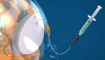 CraniUS NeuroPass device blood brain barrier