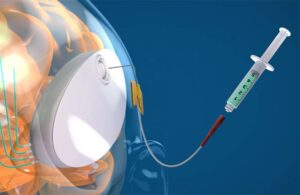 CraniUS NeuroPass device blood brain barrier