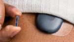 Senseonics Eversense 365 on arm with implant